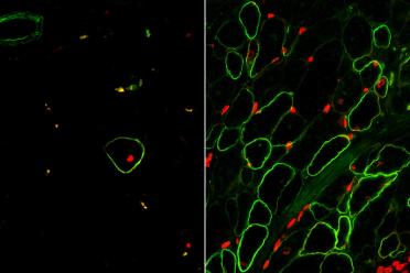 Skeletal muscle cells isolated using the ERBB3 and NGFR surface markers (right) restore human dystrophin (green) after transplantation significantly greater than previous methods (left).