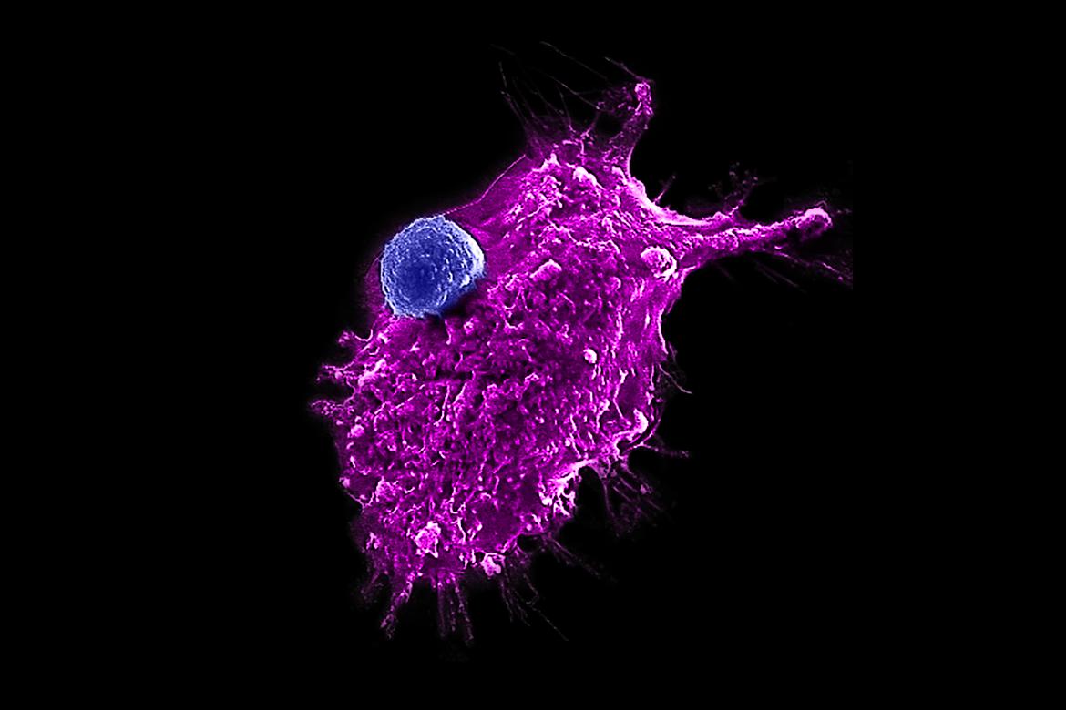 An engineered HSC-iNKT cell attacking a human tumor cell