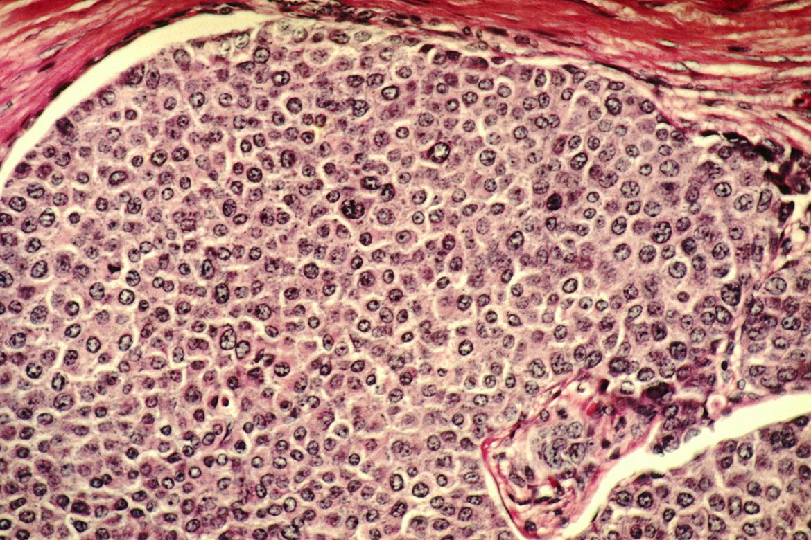 Microscopy image of breast cancer cells