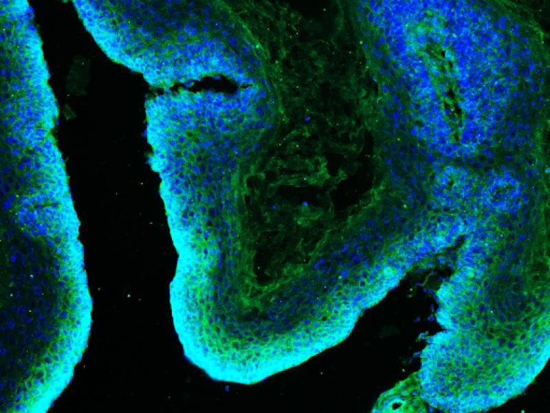 Microscopy image of a skin tumor (squamous cell carcinoma).