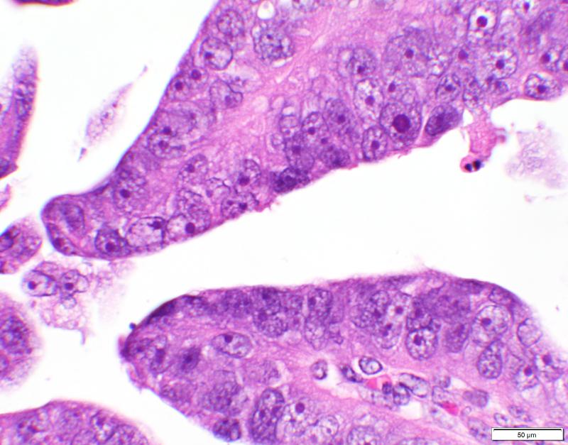Microscopy image of uterine papillary serous carcinoma, an aggressive subtype of endometrial cancer.