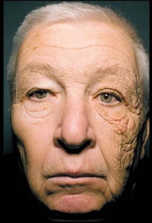 A close-up image of a man's face, more wrinkled on one side than the other.