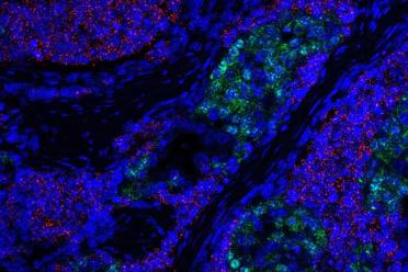 In a new study, UCLA researchers demonstrated how two subsets of small cell neuroendocrine prostate cancer tumor cells (shown in red and green) can arise from less aggressive prostate tumors.
