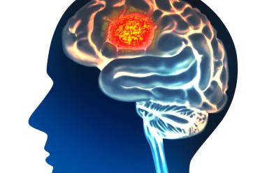 A graphic image of a brain tumor.