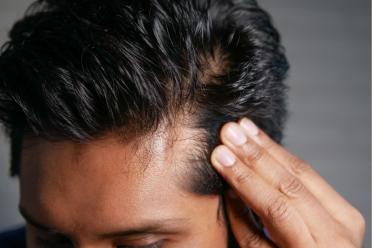 A photograph of a man's hairline.