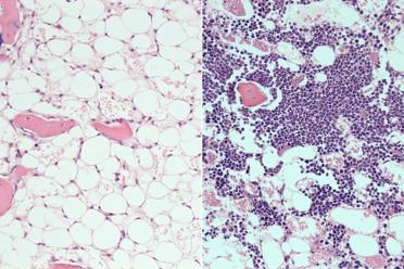 Bone marrow showing a loss of blood cells in mice after radiation (left) and then after treatment with the PTP-sigma inhibitor (right), where the recovery of blood cells is visible.