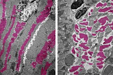 Heart muscle cells in an uninfected mouse (left) and a mouse infected with SARS-CoV-2 (right) with mitochondria seen in pink. The disorganization of the cells and mitochondria in the image at right is associated with irregular heartbeat and death.