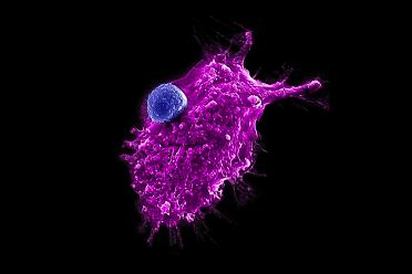 An engineered HSC-iNKT cell (blue) attacking a human tumor cell. 