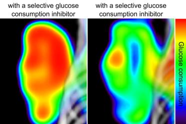 Before and after: The tumor pictured on the left has metabolized a high amount of glucose, the sugar it needs to grow. The same tumor is shown on the right after it has been treated with a molecule that prevents it from consuming glucose.