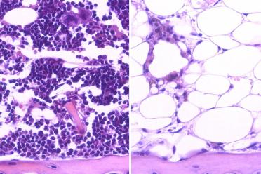 After radiation, blood cells (purple) regenerated in the bone marrow of mice that were given DKK1 intravenously (left), but not in those that received saline solution (right).