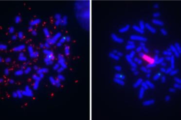 Melanoma cell lines can harbor BRAF gene amplification (red signal) in two remarkably different modes, as extrachromosomal DNA (ecDNA) (left) and as an intrachromosomal homogeneously staining region (HSR) (right)