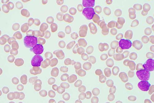 Microscopic blood smear showing normal red blood cells and several large purple-stained lymphoblasts characteristic of B-lymphoblastic leukemia