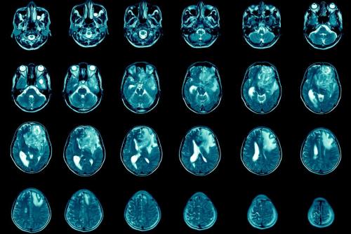 Images of blue-tinted brain scans shown tiled over a black background.