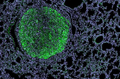 Fluorescence microscopy image of a kidney cancer metastasis (bright green nodule) within mouse lung tissue (purple background with dark spaces for airways).