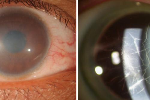 Two side-by-side close-up images of an eye showing cloudy corneal changes, including a hazy gray opacity across the front of the eye and a magnified slit-lamp view with visible corneal irregularities.