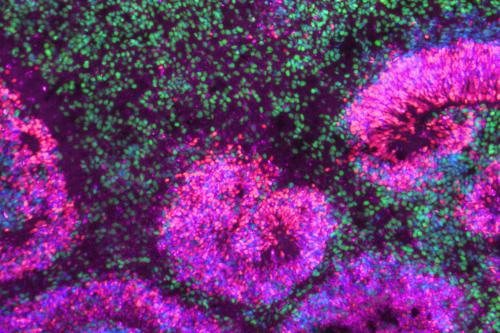 Dense fluorescent tissue with swirling pink rosette structures and green cells.
