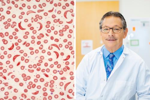 Left: An AI-generated illustration of red blood cells, including sickled forms, to represent a blood sample from a patient with sickle cell disease. Right: Dr. Donald Kohn.