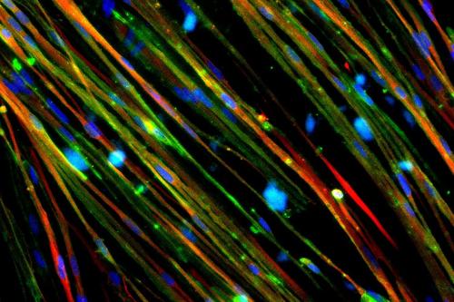 Duchenne muscular dystrophy is caused by a mutation in the gene for the dystrophin protein, which protects muscle cells from damage and loss. The restoration of dystrophin (stained green) in Duchenne muscle cells is shown above.