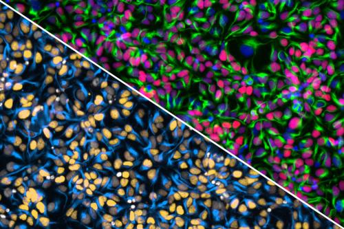 "Split fluorescence microscopy image of a neural progenitor cell village, divided diagonally. The top right shows cells with green cytoskeletal filaments and nuclei stained in pink, purple, and blue. The bottom left shows the same field with nuclei highlighted in orange, gray, and white against blue-stained cell bodies