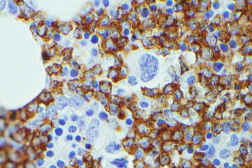 microscopy image of large leukemia cells in blue and normal blood cells in blue but smaller sized