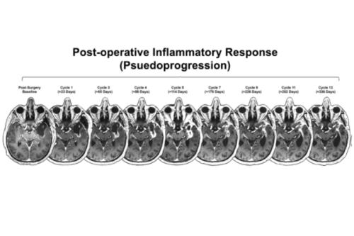 A brain scan graphic over several cycles of inflammation