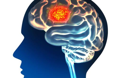 A graphic image of a brain tumor.