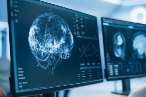 A computer screen displaying a brain scan.