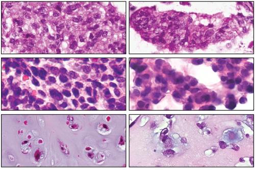 Microscopy image of desmoplastic small round cell tumor, Ewing sarcoma and chondrosarcoma. Tumors are on the left and organoids on the right. 