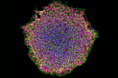 Fluorescent confocal image of a human induced pluripotent stem cell colony from an OCA1A patient, stained for OCT4 (red), SSEA4 (green), and nuclei (blue).