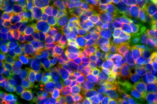 Microscopic image of small cell neuroendocrine prostate cancer: cancer cells are seen expressing diagnostic prostate cancer markers in green and red (blue color indicates the cell nucleus).