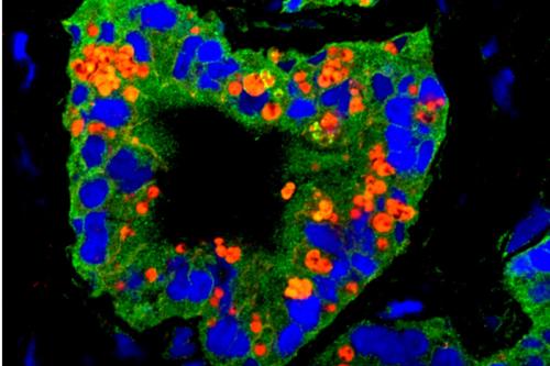 In this microscopic image of a prostate tumor, cancer cells (nuclei in blue) are seen expressing different stem cell traits (in green and red). The yellow areas indicate where the two stem cell traits are expressed together.