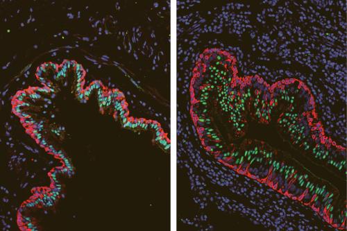 Healthy airways (left) show well-defined layers of ciliated cells (green) and basal stem cells (red). In airways affected by cystic fibrosis (right), the layers are disrupted, and scientists identified a transitioning cell type that combines properties of both stem cells and ciliated cells (red and green in the same cell).