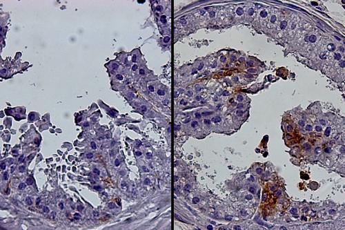 Cellular images of a young mouse prostate (left) and a prostate in an older mouse (right). The older prostate contains more luminal progenitor cells (brown).