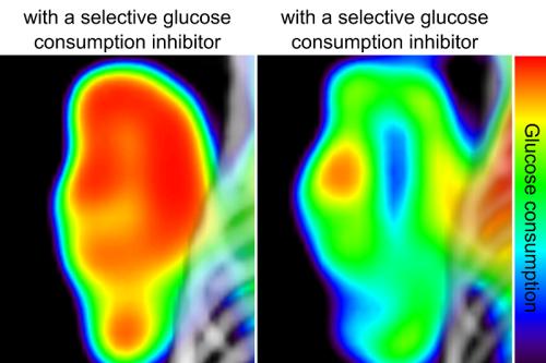 Before and after: The tumor pictured on the left has metabolized a high amount of glucose, the sugar it needs to grow. The same tumor is shown on the right after it has been treated with a molecule that prevents it from consuming glucose.