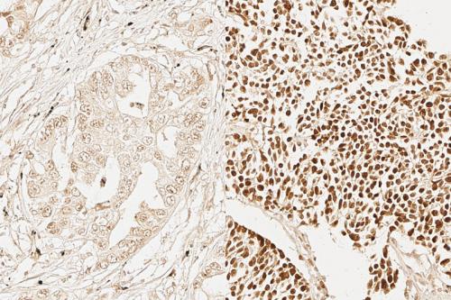 Image shows the expression of an adult stem cell signature marker (dark brown) in less aggressive lung cancer cells (left) and highly aggressive lung cancer cells (right).