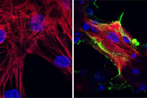 Microscope images showing (left) healthy heart muscle cells and (right) heart muscle cells that have been infected and damaged by the SARS-CoV-2 virus (in green). | Credit: UCLA Broad Stem Cell Research Center/JCI Insight