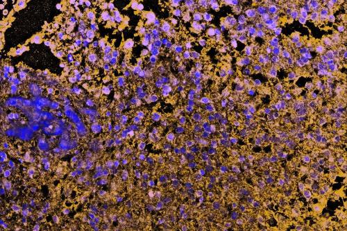 Cells in a glioblastoma with the deletion in the CDKN2A gene.