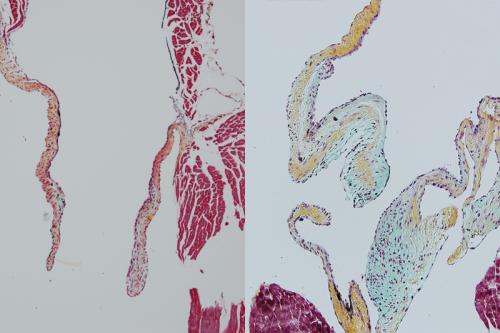 Microscopic images of a normal heart valve in a mouse, left, and a heart valve grown in a lab with heart-derived macrophages blocked, right. Without those macrophages, the valves are thick and deformed.