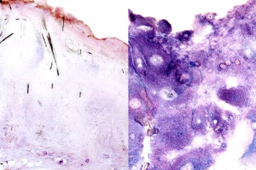 Image shows squamous cell skin cancer tumors with lactate production (a byproduct of glucose consumption) in purple. The tumor with lactate production blocked (left) grew at the same rate as the tumor with normal lactate production (right).
