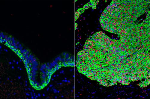 Normal airway tissue, left, and lung cancer tissue, right, with an overabundance of basal stem cells (green). The activated form of beta-catenin (red) in the lung cancer can be targeted by the Wnt Inhibitor Compound 1.