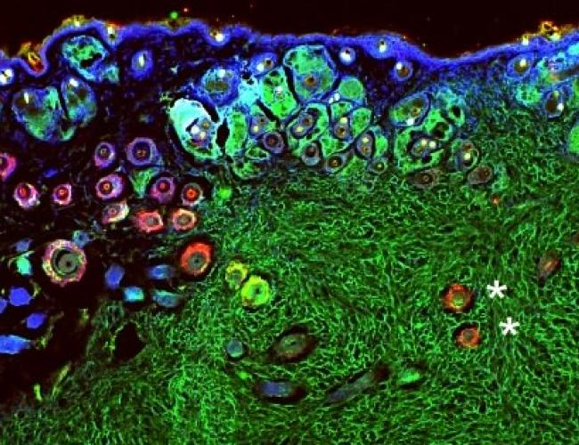 Microscopy image of tumor