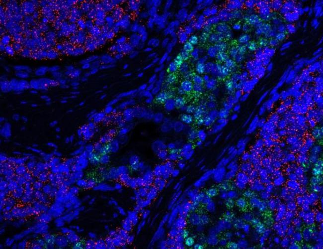 In a new study, UCLA researchers demonstrated how two subsets of small cell neuroendocrine prostate cancer tumor cells (shown in red and green) can arise from less aggressive prostate tumors.