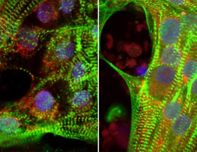 Human heart cells grown from stem cells show less robust muscle fibers (green) in high glucose conditions (left) compared to reduced glucose conditions (right).