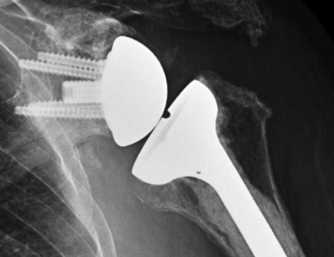 X ray image showing bones