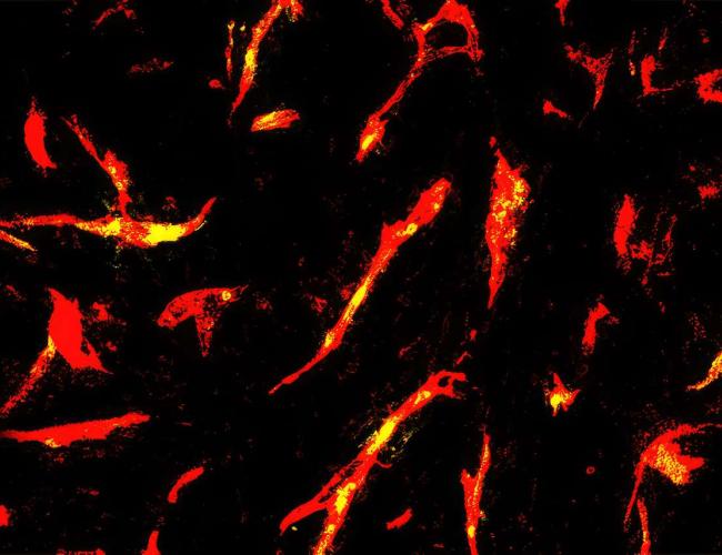 Microscopy image of blood vessels (red) in a mouse glioma tumor after CAR-T cell treatment. Yellow shows areas with good blood flow, highlighted using tomato lectin, a protein that marks vessels. 