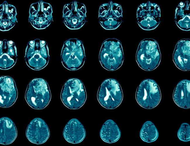 Images of blue-tinted brain scans shown tiled over a black background.