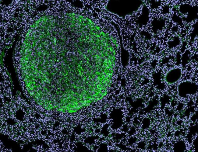 Fluorescence microscopy image of a kidney cancer metastasis (bright green nodule) within mouse lung tissue (purple background with dark spaces for airways).