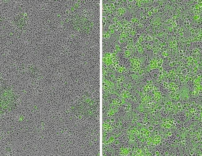 CAR T-cell clusters attacking tumor cells as seen through a microscope