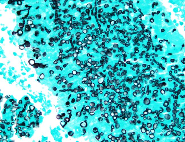 Very high magnification micrograph of coccidioidomycosis, also known as valley fever and California disease.