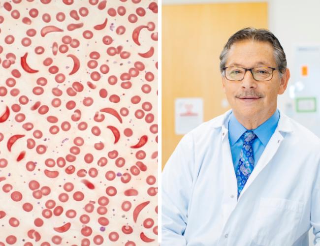 Left: An AI-generated illustration of red blood cells, including sickled forms, to represent a blood sample from a patient with sickle cell disease. Right: Dr. Donald Kohn.